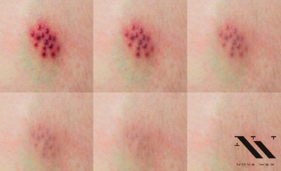 Histamine Reaction and Solution
