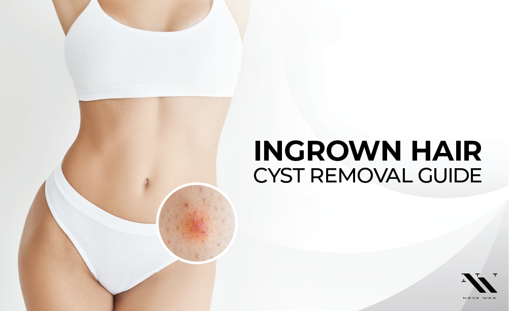 Ingrown hair cyst removal deals